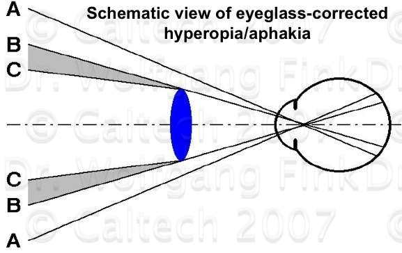 Side view schematic of corrected hyperopia due to aphakia through an eyeglass lens.